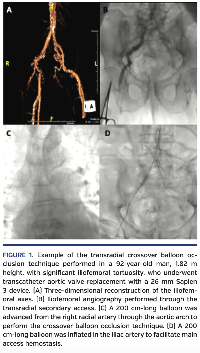 Transradial Crossover Balloon Occlusion Technique for Primary Access